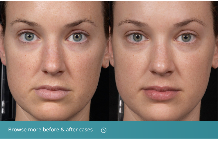 Clear Brilliant Laser Skin Treatment Beverly Hills, CA Moy, Fincher, Chipps Facial Plastics
