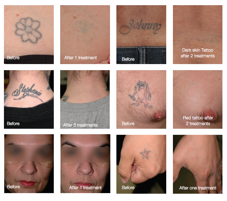 laser tattoo removal treatment in beverly hills ca moy fincher laser tattoo removal treatment in beverly hills ca moy fincher