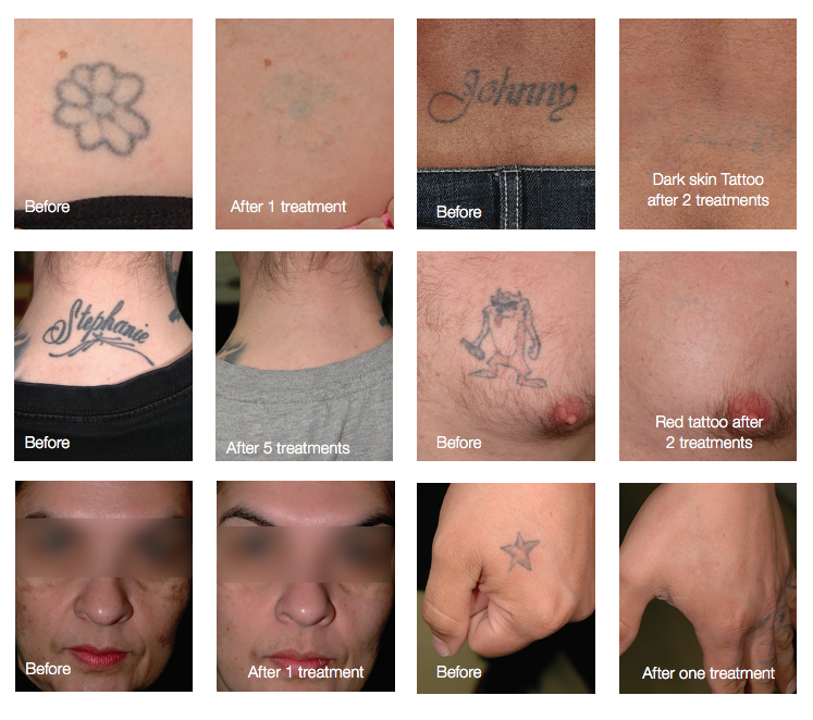 10 PiQo4 Laser ideas  laser tattoo removal tattoos