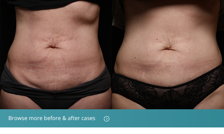 Non-Surgical Fat Removal Review - Vanquish Liposuction Results