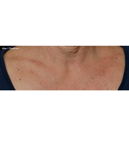 Fractionated CO2 Laser Treatment Beverly Hills, CA - Moy, Fincher, Chipps