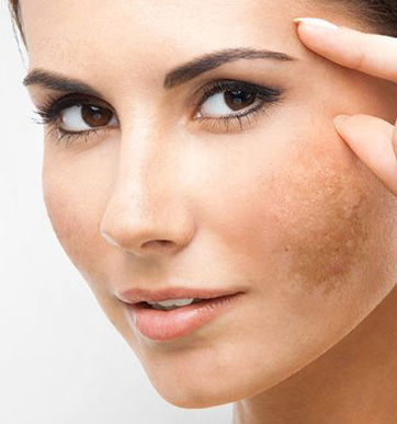 Age Spots (Liver Spots) Treatment Beverly Hills