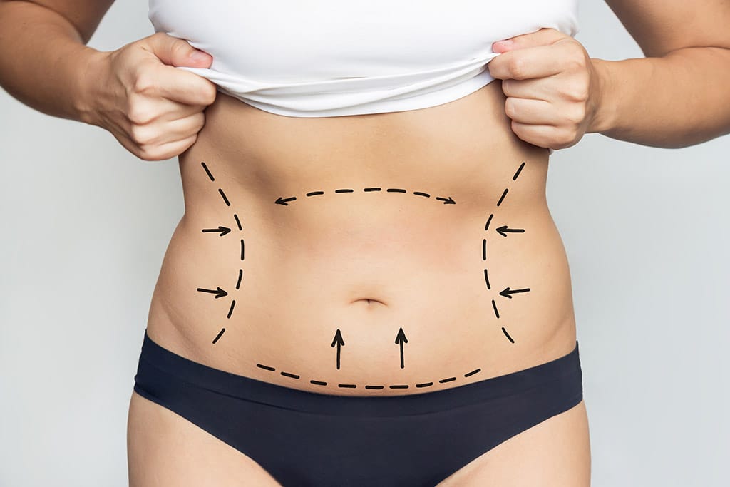 Liposuction Austin