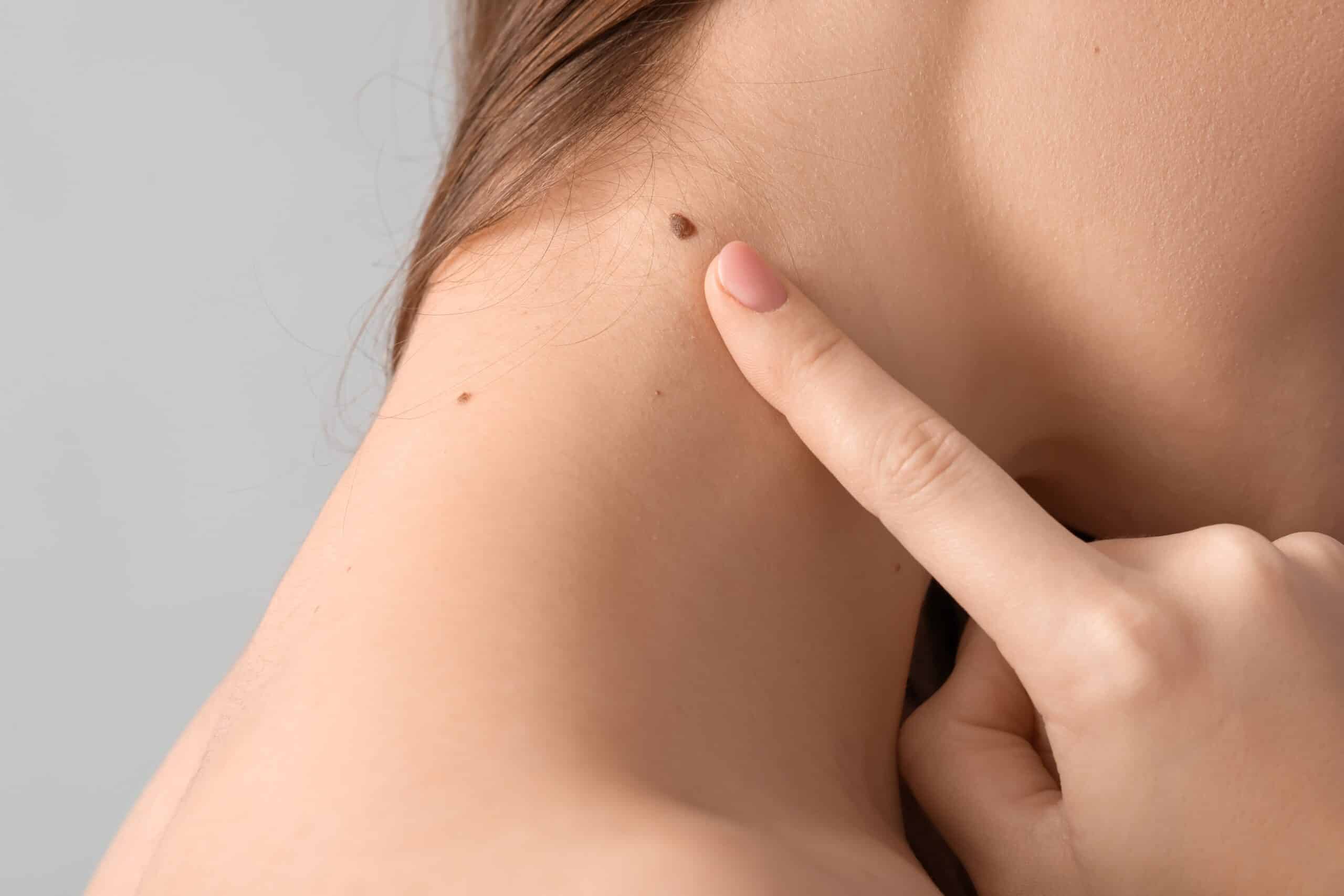 Normal Mole Variation What are the Key Differences Between Normal Moles and Atypical Nevi ...