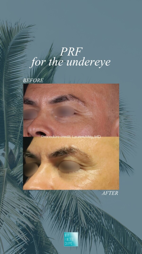 PRF: Your Skin, Rejuvenated NaturallySee the transformation with PRF (Platelet-Rich Fibrin)—a regenerative treatment using your own growth factors to smooth, plump, and refresh the skin.

No fillers, no chemicals—just powerful results from within.

Procedure credit: lmoymd

Book your consultation today!

3 easy ways to book:
Book Online: link in bio
Text: 424.496.3537
Call: 310.274.5372

MoyFincherChipps BeverlyHills LA LosAngeles LASkin CosmeticDermatology PRF PRFInjections UnderEyeRejuvetation